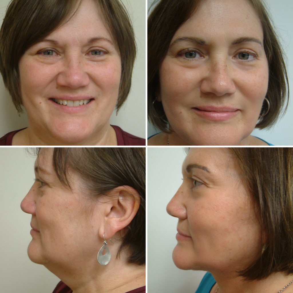 Before and after images