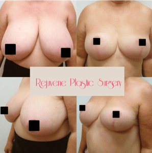 before and after Breast Reduction Cincinnati OH