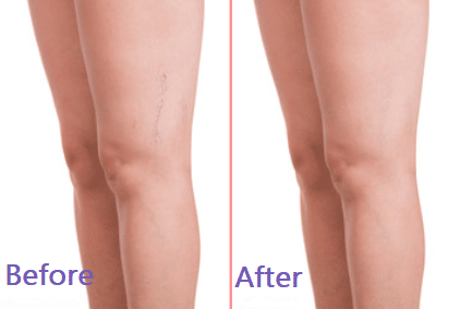 before after Spider Veins Treatment Cincinnati OH