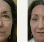 before and after Browlift Cincinnati OH