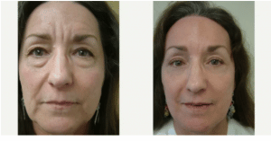 before and after Browlift Cincinnati OH