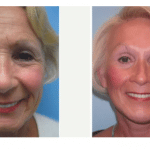 before and after Facelift Hebron KY