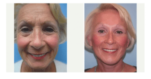 before and after Facelift Hebron KY
