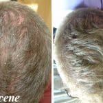 before and after Hair Regeneration Cincinnati OH