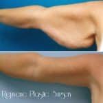 before and after Arm Lift Cincinnati OH