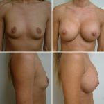 before after Breast Augmentation Cincinnati OH