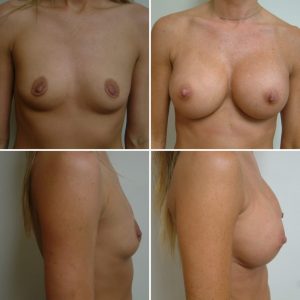 before after Breast Augmentation Cincinnati OH