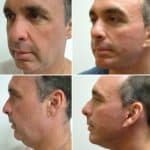 before and after Facelift Cincinnati OH