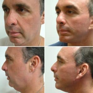 before and after Facelift Cincinnati OH