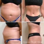 front and side view of woman’s bare stomach before and after tummy tuck, flatter after procedure