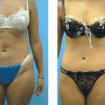 tummy tuck