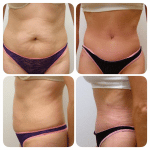 tummy tuck