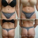 front and rear view of woman wearing underwear before and after tummy tuck, less fat on stomach and back after procedure