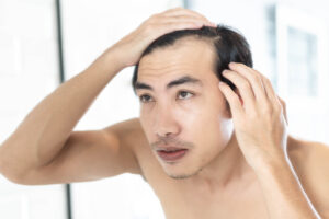 A man looking in the mirror considering PRP and stem cell hair rejuvenation